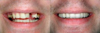 Smile Gallery - Hanover Dental, Hanover Park Dentist