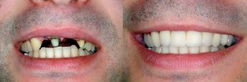 Smile Gallery - Hanover Dental, Hanover Park Dentist