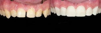 Smile Gallery - Hanover Dental, Hanover Park Dentist