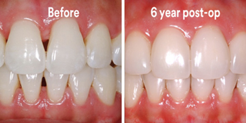 BioClear Diastema Closure and Black Triangle Closure  - Hanover Dental, Hanover Park Dentist