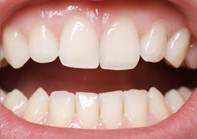 Cosmetic Bonding  - Hanover Dental, Hanover Park Dentist