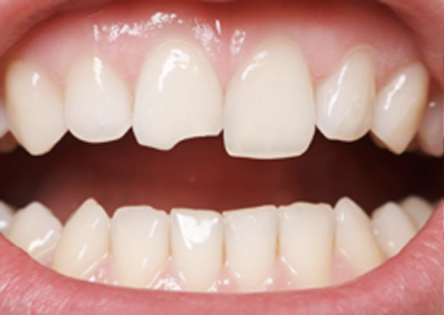 Cosmetic Bonding  - Hanover Dental, Hanover Park Dentist