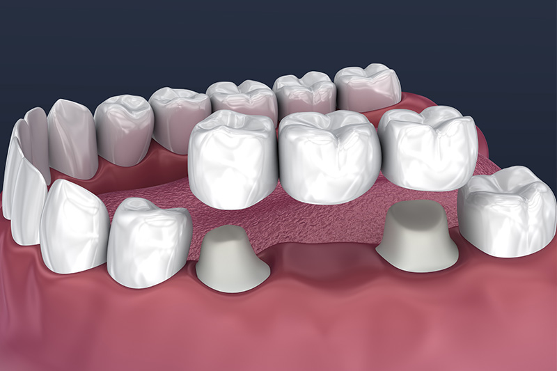 Crowns and Bridges, Inlays and Onlays  - Hanover Dental, Hanover Park Dentist