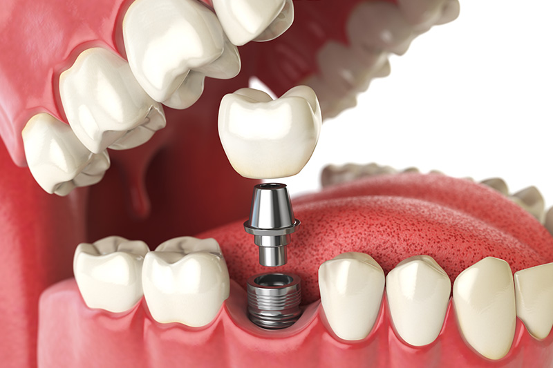 Dental Implants - Hanover Dental, Hanover Park Dentist