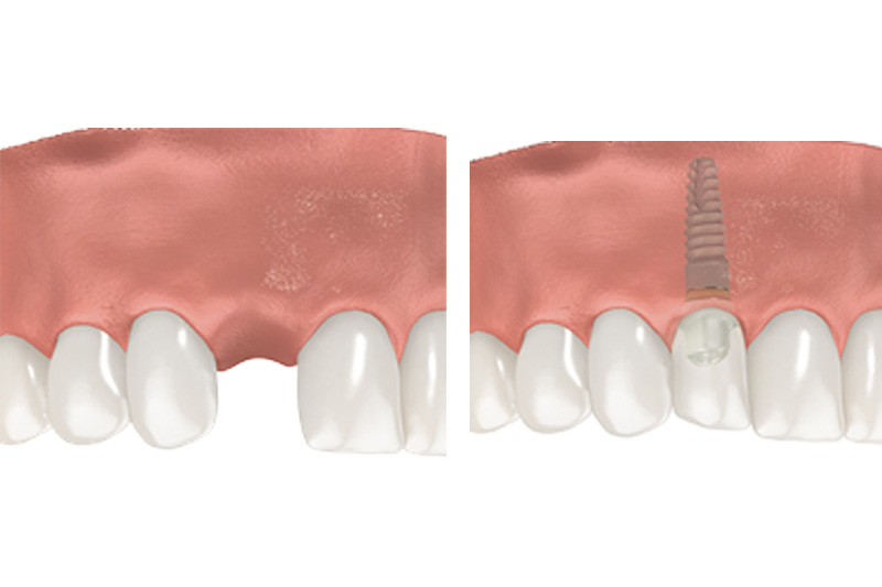 Dental Implants - Hanover Dental, Hanover Park Dentist