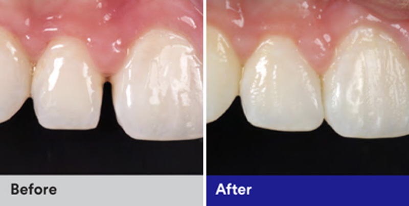 BioClear Diastema Closure and Black Triangle Closure  - Hanover Dental, Hanover Park Dentist