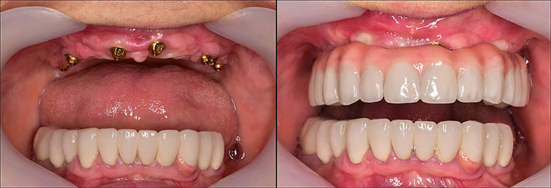 Implant Overdentures and Fixed All-On-X Treatment  - Hanover Dental, Hanover Park Dentist
