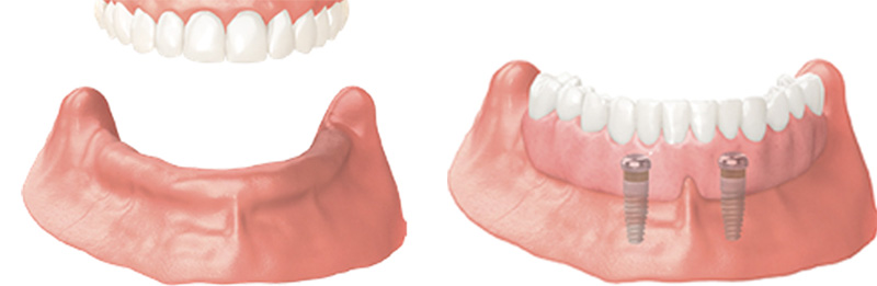 Implant Overdentures and Fixed All-On-X Treatment  - Hanover Dental, Hanover Park Dentist