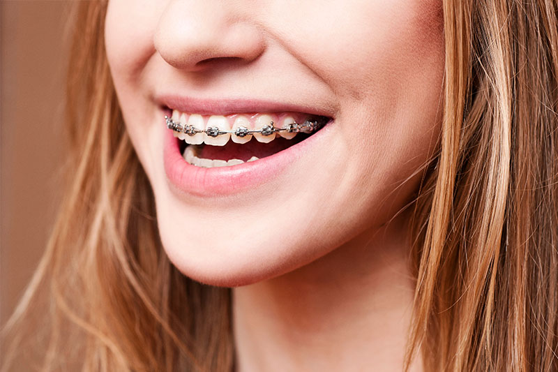 Orthodontics - Hanover Dental, Hanover Park Dentist