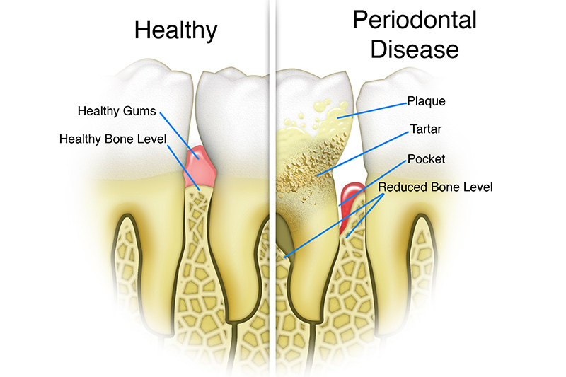 Scaling & Root Planings (Deep Cleanings)  - Hanover Dental, Hanover Park Dentist