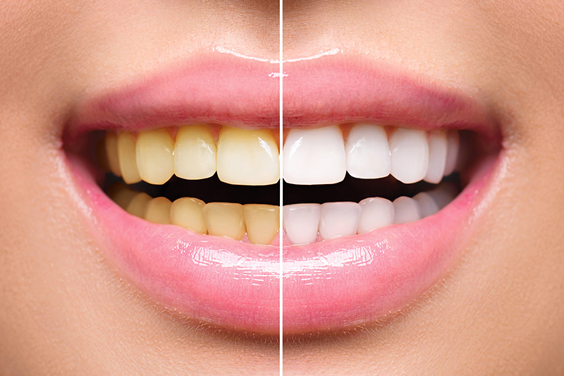 Teeth Whitening - Hanover Dental, Hanover Park Dentist