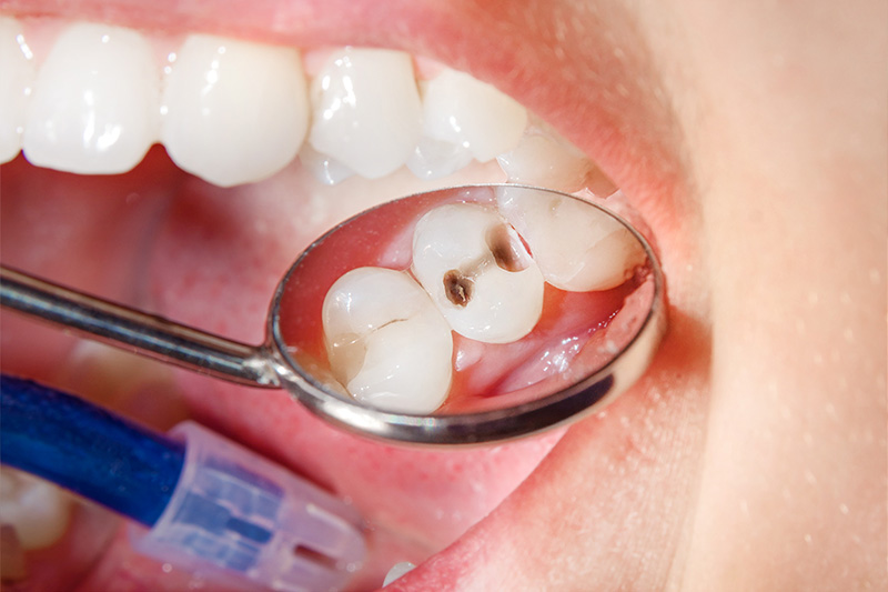 Tooth Colored Composite Fillings  - Hanover Dental, Hanover Park Dentist