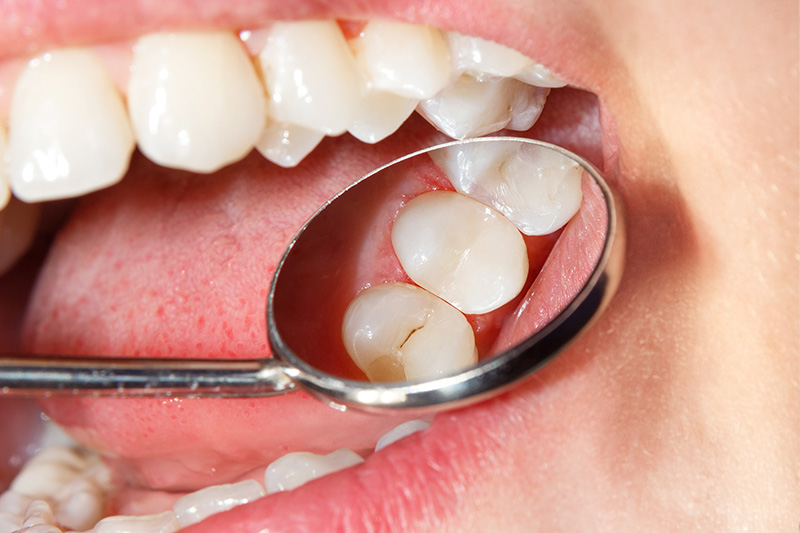 Tooth Colored Composite Fillings  - Hanover Dental, Hanover Park Dentist