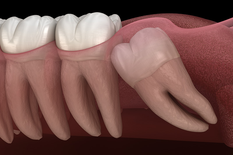 Extracciones de Muelas del Juicio (con Sedante)  - Hanover Dental, Hanover Park Dentist